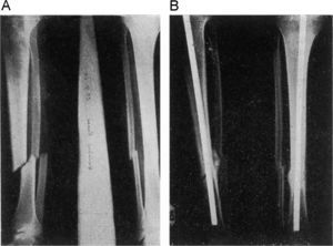 C.H.G. Fractura cerrada oblicua, unión tercio-medio con inferior de tibia y peroné. A: radiografías de la fractura. B: imagen radiográfica a los tres meses.