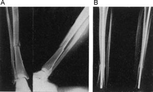 F.B.H. Fractura transversal de tibia con peroné intacto. A: radiografías previas (nótese la tendencia al rarismo a nivel del foco de fractura). B: imagen radiográfica de consolidación ósea completa a los dos meses.