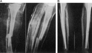 F.M.M. Fractura transversal de tibia y peroné abierta. A: radiografías previas. B: imagen radiográfica con consolidación ósea completa al mes. Este enfermo fue dado de alta para el trabajo al mes de medio.