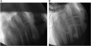 Control radiológico de la osteotomía (A,B). En la imagen de la derecha (B) se traccionan los dedos; la osteotomía del cuarto metatarsiano se ha ejecutado demasiado proximal.