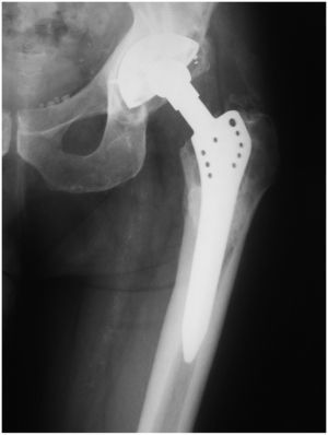 Artroplastia de cadera de 22 años de evolución, aunque se realizó recambio del componente acetabular 4 años antes por movilización aséptica.