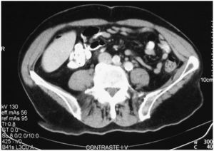 Tomografía computarizada pélvica postoperatoria (resolución del absceso).