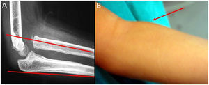 Luxación crónica postraumática de la cabeza radial (A) presentada como tumoración en la fosa antecubital (B).