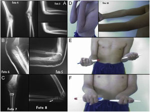 Caso 1, imágenes radiográficas iniciales (A), postoperatorias (B) y al final del período de seguimiento (C); imágenes clínicas de la movilidad final (D, E, F).