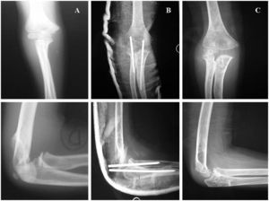 Caso 2, imágenes radiográficas iniciales (A), postoperatorias (B) y al final del período de seguimiento (C).