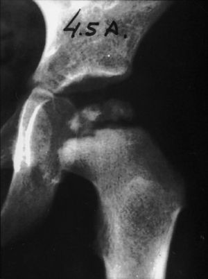 Radiografía anteroposterior de cadera en un niño de 4 años y medio. Se observa necrosis de la cabeza femoral y destrucción de la parte lateral de ésta.
