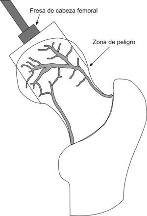 Circulación intraósea en la cabeza femoral a partir de los vasos retinaculares. Obsérvese la proximidad con la superficie ósea en la zona superolateral del cuello, que puede lesionarse si se hace una muesca en el cuello al implantar la prótesis.