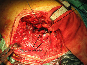 Reparación de la cápsula articular tras una artroplastia de superficie de cadera por vía posterior.