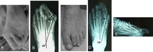 A) Varón de 41años, aspecto del pie izquierdo con pronación del primer dedo y segundo dedo supraductus. B) Estudio radiológico antes de la cirugía. C) Técnica quirúrgica asociada a Regnauld: osteotomía proximal del primer metatarsiano. Evolución final a los 2 años; aspecto. D) y E) correcciones angulares; corrección del ángulo metatarsofalángico en 22° y del intermetatarsal en 12°. Escala de la American Orthopaedic Foot and Ankle Society: 95 puntos, valoración subjetiva excelente.