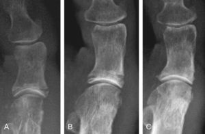 Evolución de la osteotomía en un mismo caso. A) 10 días. B) 4 semanas. C) 2 años tras la cirugía. Nótese la progresiva integración.
