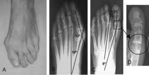 Varón de 72 años. A) Aspecto macroscópico del pie izquierdo. B) Estudio radiológico antes de la cirugía. C) Evolución final a los 2 años. D) Integración de la osteotomía.