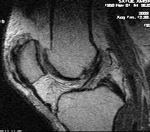 Resonancia magnética nuclear de rodilla derecha con gap en tendón cuadricipital.