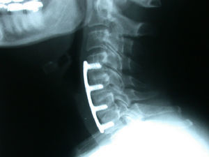 Discectomía y fusión cervical anterior a 3 niveles con fusión 2 años tras la intervención con un autoinjeto tricortical de cresta ilíaca.