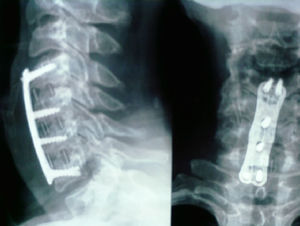 Discectomía y fusión cervical anterior a 3 niveles con fusión 2 años tras la intervención con cajetín de PEEK (polietercetona) y aloinjerto.