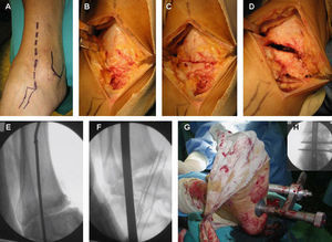 Técnica quirúrgica. A) incisión anterolateral a unos 6 cm proximal y anterior a la punta del maléolo peroneo, se incurva en esta zona hasta la base del cuarto metatarsiano. B y C) No se realizó osteotomía de los 3cm distales del peroné, lo que permitió el acceso fácil a ambas articulaciones. D) Se llevó a cabo la preparación de las superficies articulares y la resección del cartílago articular. E) Se llevó a cabo la introducción de la guía del clavo con punta roscada bajo control radioscópico. F) Se llevó a cabo el fresado progresivo a través de la guía. G y H) Una vez introducido el clavo deseado se comprobó la alineación y se colocó la guía externa para introducir los tornillos transversales a la altura proximal en tibia y a la altura distal en calcáneo.