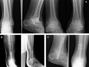 Caso n.o 6. A) Imágenes radiográficas anteroposterior, lateral y oblicuas iniciales. B) Imágenes radiográficas postoperatorias. C) Imágenes radiográficas al final del período de seguimiento.