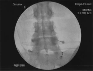 Imagen posteroanterior de fluoroscopia intraoperatoria, que muestra la posición de los electrodos de rizolisis respecto a los niveles L5 y S1.