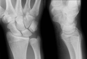 Radiografía anteroposterior y perfil de la seudoartrosis de hueso grande a los 5 meses del antecedente traumático.