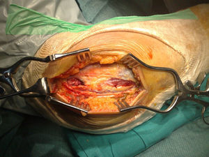 Lesión del origen común de la musculatura extensorasupinadora. Abordaje lateral del codo. Tras la incisión de la aponeurosis superficial la musculatura se halla desinsertada del húmero distal.