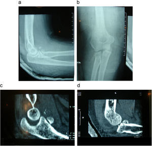 Tríada terrible de codo. La fractura de la cabeza radial se asocia a fractura de pequeño tamaño de la coronoides. El estudio mediante tomografía computarizada muestra la pérdida de congruencia articular humerocubital y la subluxación posterolateral de la cabeza radial.