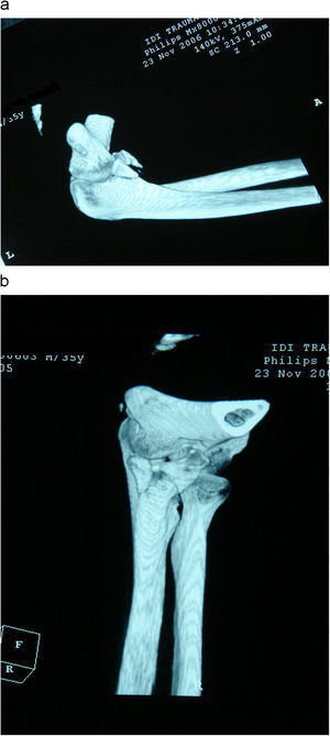 Fractura de coronoides tipo ii según la clasificación descrita por O’Driscoll et al (O’Driscoll, 2003) que en este caso afecta a la faceta anteromedial y a la punta de la coronoides.