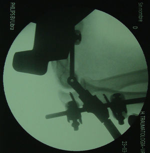 Colocación del fijador externo. Es preciso obtener una proyección lateral estricta peroperatoria para determinar correctamente el centro de rotación de la articulación. El capitéllum y la tróclea quedan superpuestas.