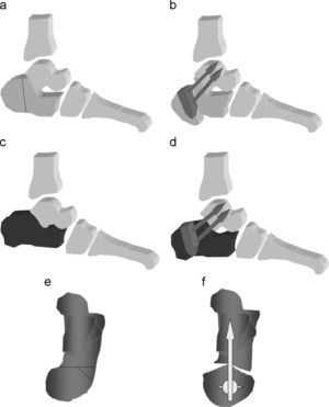 Representación esquemática de las técnicas de corrección empleadas en este estudio. A y B) Osteotomía tipo Romash de deslizamiento y valguización. C y D) Distracción y varización. E y F) Osteotomía en cuña de sustracción adición valguizante.