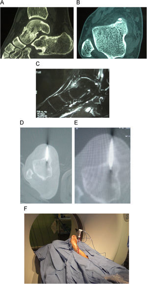 A) Osteoma osteoide de cuello de astrágalo en un varón de 38 años, imagen de tomografía computarizada (TC), corte sagital. B) corte axial del osteoma. C) Localización de la lesión mediante resonancia magnética. D) Introducción de la aguja de biopsia ósea en el centro del nidus. E) Comprobación de la colocación de la aguja de radiofrecuencia. F) Situación del enfermo en el gantry de la TC con la aguja de radiofrecuencia ya situada.
