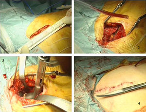 Abordaje lateral mínimamente invasivo.