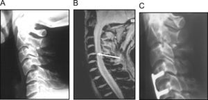 Fractura por flexión-distracción. A) Imagen radiográfica de lesión a la altura de C4-C5. B) Imagen de RMN en la que se observa hernia traumática que produce radiculopatía sensitivomotora. C) Imagen radiográfica postoperatoria tras extirpación de la hernia, discectomía y fusión intersomática C4-C5 con injerto autólogo tricortical de la cresta estabilizado con placa autoestable.