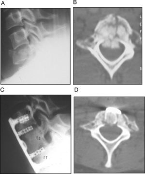 Fractura-compresión vertical de C7. A) Imagen radiográfica preoperatoria. B) Imagen de la TAC preoperatoria. C) Imagen radiográfica postoperatoria tras corpectomía subtotal de C7, fusión con injerto autólogo y fijación con placa autoestable de C6-T1. D) Imagen de la TAC postoperatoria.