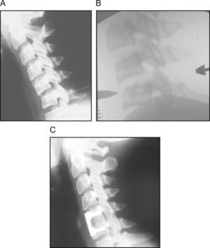 Lesión traumática del complejo ligamentario posterior C5-C6. A) Aumento de la distancia interespinosa en radiografía dinámica. B) Imagen inmediata preoperatoria obtenida en el fluoroscopio que muestra clara inestabilidad con una suave maniobra de flexión. C) Control radiográfico a los 12 años postoperatorio tras la estabilización quirúrgica por vía anterior.