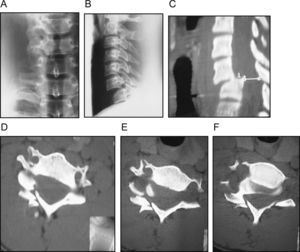 Subluxación C6-C7 que produce clínica de radiculopatía sensitivomotora C7 derecha preoperatoria. A) Imagen radiográfica anteroposterior. B) Imagen radiográfica lateral. C) Imagen de la TAC. D, E y F) Imagen de la TAC, en las que observamos fractura de láminas derechas C6-C7, fractura articular inferior de C6 y superior de C7 con luxación facetaria, fractura de la apófisis transversa derecha de C6 con afectación del foramen transverso, fractura de la apófisis transversa C7, fractura compresión cuerpo C7 y subluxación C6-C7.
