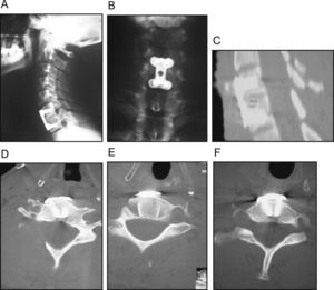 Evolución a los 12 meses postoperatorio, abordaje combinado subluxación C6-C7. A) Imagen radiográfica lateral. B) Imagen radiográfica anteroposterior. C) Imagen de la TAC. D, E y F) Imagen de la TAC postoperatoria.