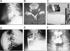 Luxación bifacetaria completa C6-C7. A) Imagen radiográfica preoperatoria. B) TAC que muestra luxación en corte axial. C) Tracción progresiva con halo hasta obtención de reducción. D) Imagen en fluoroscopio intraoperatoria que muestra la reducción obtenida con halo. E y F) Imagen radiográfica de la fusión intersomática a los 7 años.