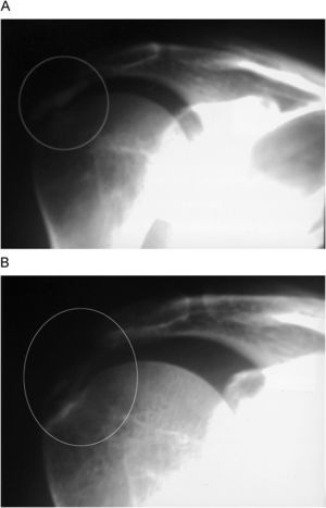 Restos parciales de calcificación tras la realización de la cirugía artroscópica. A) Radiología preoperatoria. B) Radiología postoperatoria.