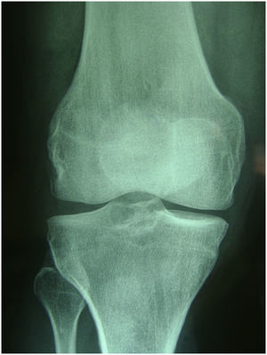 Radiografía simple de la rodilla afectada en el caso número uno.