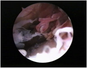 Visión artroscópica que muestra sinovitis nodular.