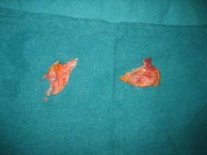 Cápsula anterior y posterior tras resección. Nótese el engrosamiento capsular.