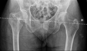 Imagen radiográfica anteroposterior de pelvis de una paciente de 82 años con una fractura subcapital de fémur derecho. Inicio de la planificación mediante el trazado de la línea horizontal (H) de referencia pélvica, dibujada entre ambas imágenes en lágrima.