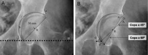 Plantillado del componente acetabular. A) La imagen muestra un componente acetabular de tamaño y posición adecuados. B) Imagen que muestra la utilidad de la distancia (d) entre el borde inferomedial del componente acetabular y el vértice inferior de la imagen en lágrima para determinar la inclinación acetabular precisa. La distancia (d) en una copa con una inclinación correcta (45°) aumenta a una distancia (d’) con el incremento de la inclinación del componente acetabular (A’ a 60° de inclinación). Por otra parte, con el incremento de la inclinación de la copa acetabular, reduciremos la cobertura lateral de la copa, que se ve reflejado en la menor distancia entre el vértice superior de la copa y el borde acetabular superoexterno. a: borde acetabular superoexterno; A: componente acetabular con inclinación correcta; A’: componente acetabular verticalizado; b: línea ilioisquiática; c: imagen en lágrima; d: distancia del componente acetabular correcto; d’: distancia del componente acetabular verticalizado; e: distancia entre el vértice superior de la copa y el borde acetabular superoexterno; H: línea horizontal de referencia; R: centro de rotación del componente acetabular.