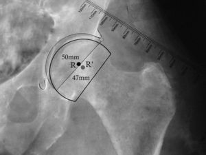 Plantillado de la copa bipolar. La imagen muestra la posición más caudal y lateral del centro de rotación de la copa bipolar en comparación con el centro de rotación del componente acetabular. También se muestra el menor diámetro de la copa bipolar (47mm) al compararlo con el componente acetabular (50mm). R: centro de rotación de componente acetabular; R’: centro de rotación de copa bipolar.