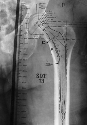 Imagen que muestra el correcto plantillado de un componente femoral en el que el eje del vástago se encuentra alineado con el eje de la diáfisis femoral (F) y cuyo tamaño permite un manto de cemento homogéneo y circunferencial (marcado con la línea de puntos) en la diáfisis femoral. *: zona proximal del trocánter menor; C: zona de elección de la osteotomía del cuello femoral; F: eje de la diáfisis femoral.