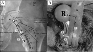 A) En esta imagen radiográfica se muestra la forma de calcular las distancias de referencia de la planificación del componente femoral. 1: distancia entre el ángulo superior del trocánter menor y la zona de osteotomía del cuello femoral; 2: distancia entre la zona medial de la osteotomía femoral y el vástago; 3: distancia entre el ángulo superior del trocánter menor y el centro de rotación de la cabeza protésica. B) Imagen intraoperatoria que muestra la forma de reproducir las medidas radiográficas de referencia sobre el fémur del paciente, tras la colocación de los componentes de prueba. Tras la identificación del centro de rotación de la cabeza femoral de prueba, del ángulo proximal del trocánter menor y del borde medial de la osteotomía cervical se utiliza una regla estéril para calcular las distancias previamente descritas (6A). *: zona proximal del trocánter menor; F: eje de la diáfisis femoral; R: centro de rotación de la cabeza protésica.