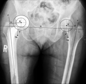 Imagen radiográfica anteroposterior de pelvis que muestra una artroplastia total de cadera por fractura (paciente de la fig. 1) implantada tras la realización de la planificación preoperatoria (tabla 1). Se comprueba la correcta posición de los implantes y la restauración anatómica de la biomecánica de la cadera fracturada (centro de rotación, offset [O=O’] y longitud del miembro [d=d’]). d: distancia vertical desde la línea de referencia al ángulo proximal del trocánter menor de la cadera operada; d’: distancia normal; F: eje de la diáfisis femoral; H: línea de referencia horizontal entre ambas imágenes en lágrima; O: offset de la cadera operada; O’: offset normal; R: centro de rotación de la artroplastia; R’: centro de rotación de la cadera normal; Tm: trocánter menor.