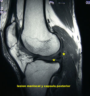 Corte sagital de la RM de la rodilla, que muestra una alteración de la señal en el cuerno posterior del menisco externo y una imagen indicativa de lesión de la cápsula posterior.