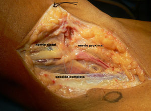 Abordaje posteroexterno de la rodilla en el que se observa la lesión completa del ciático poplíteo externo.