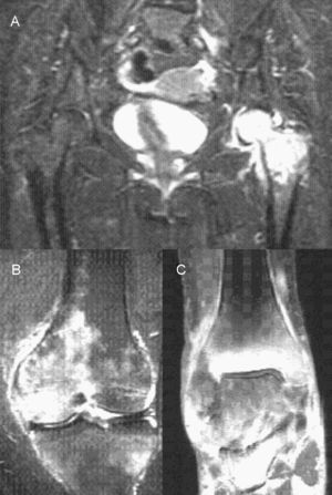 Secuencia de imágenes de resonancia magnética. A) Caderas. B) Rodilla izquierda. C) Tobillo derecho.