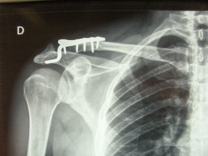 Reducción de la luxación acromioclavicular de tipo iii con placa gancho AO.