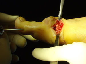 Aguja Kirschner colocada extraperiósticamente para permitir el desplazamiento.